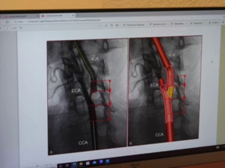 Волгоградские врачи спасли пациента от повторного инсульта