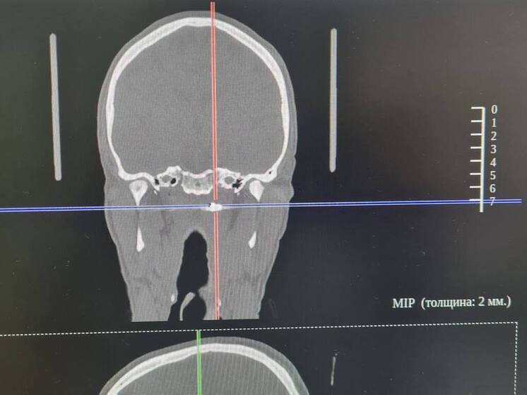 Спасли за минуту: врачи Владивостока удалили пулю из носа пациента