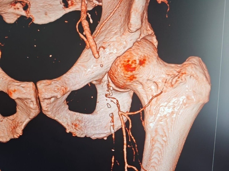 Волгоградские врачи провели более 20 сложнейших гибридных операций