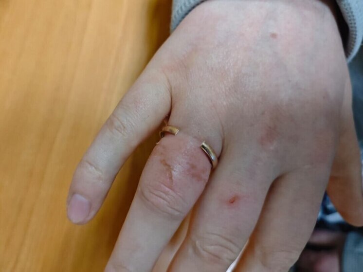Снять обручальное кольцо жителю региона помогли спасатели
