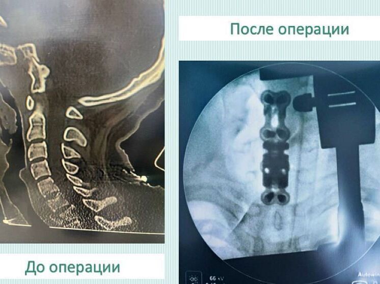 Кировские врачи вернули молодому пациенту возможность двигаться после серьёзной травмы