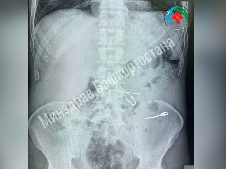 Уфимские хирурги спасли пациента, проглотившего скрепки и проволоку
