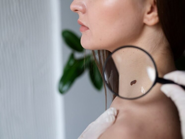 Калужан приглашают на диагностику меланомы