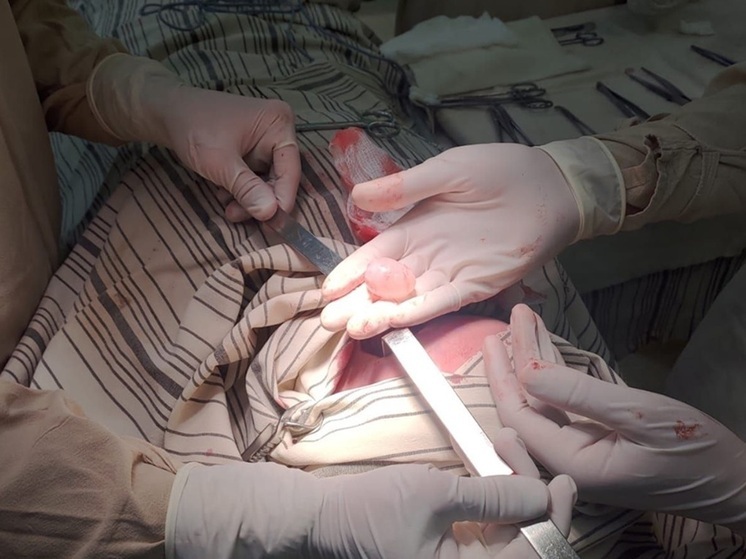 В Саратове у подростка на шее нашли жуткую опухоль с червями