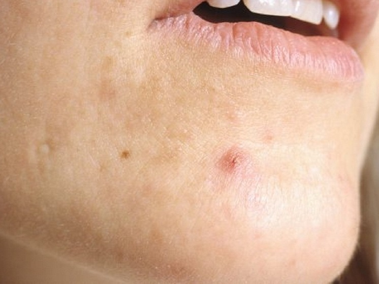 Врач Кливитская: кофеиносодержащие напитки и быстрые углеводы провоцируют акне