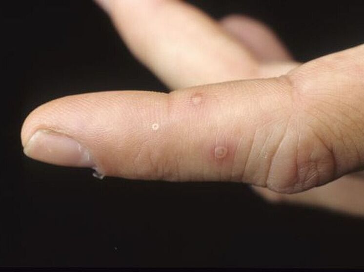 Mash: минимум 10 россиян могли заразиться вирусом Коксаки в Турции