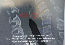 В Красноярске в приемный покой БСПМ поступили трое пациентов с тяжелыми повреждениями шейного отдела позвоночника