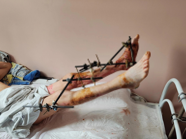 Орловские врачи спасли мужчину с раздробленными голенями