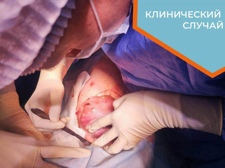 Гигантский метастаз удален в Новосибирском онкодиспансере