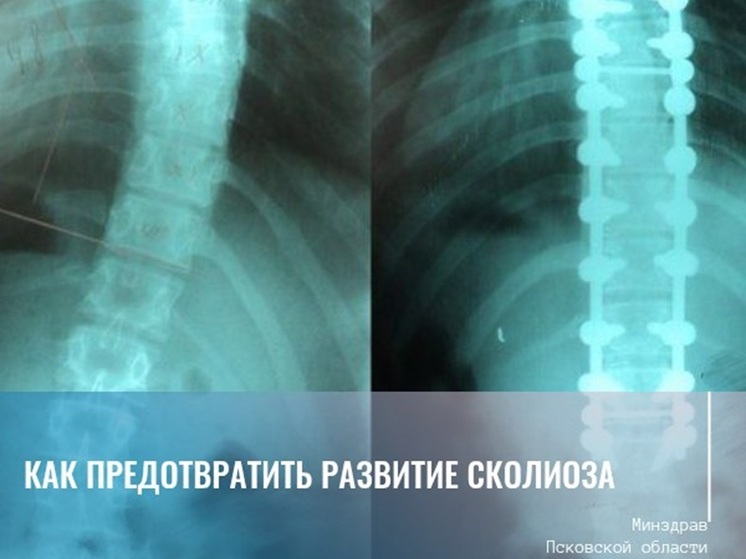 Профилактика сколиоза: псковичам дали советы о том, как сохранить здоровье позвоночника
