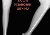Сложнейшую операцию пациенту с «хрустальными» костями провели травматологи Российской детской клинической больницы