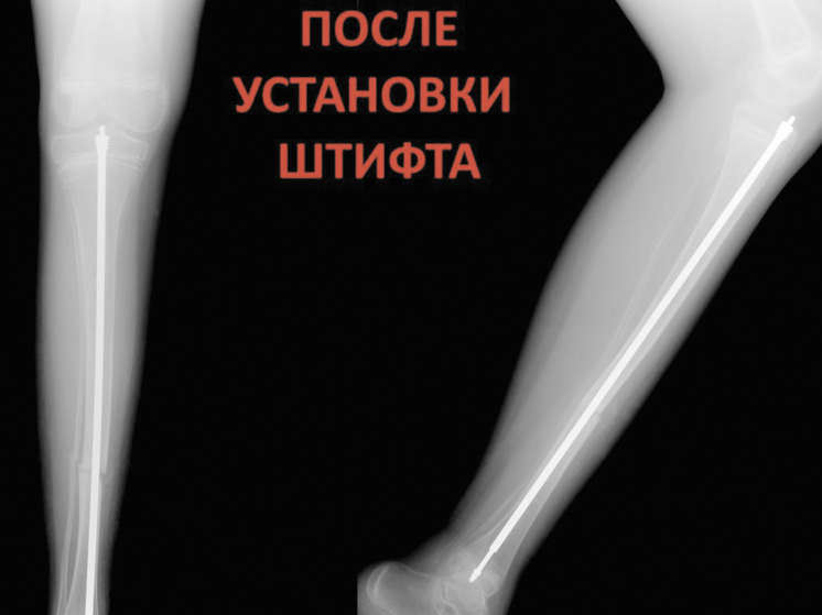 Врачам удалось укрепить кости ребенка с редким заболеванием