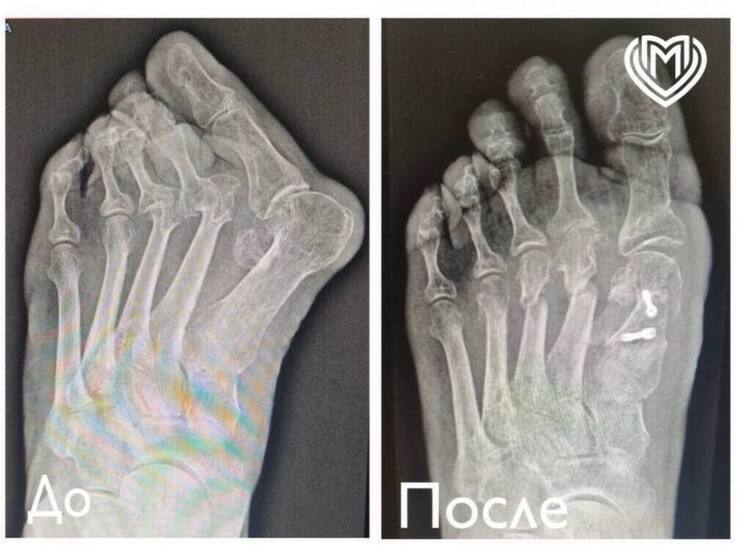 Пожилая женщина, страдавшая от Hallux valgus III степени —  вальгусной деформацией большого пальца стопы — была госпитализирована на днях в больницу