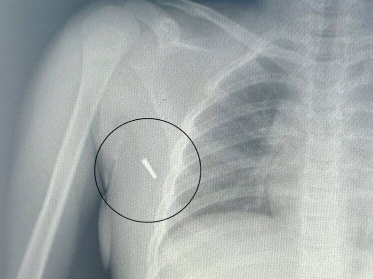 В Приморье врачи спасли 8-летнюю девочку, в тело которой вонзился ртутный градусник