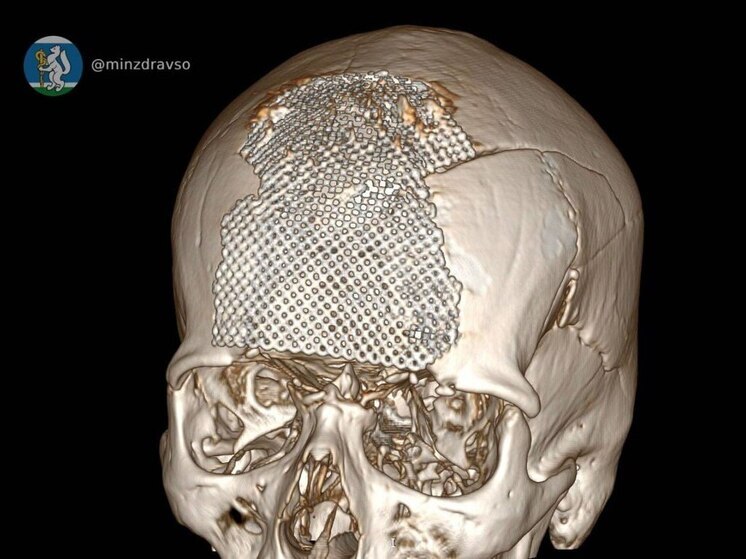 В Екатеринбурге раненному на СВО бойцу провели сложнейшую реконструкцию черепа