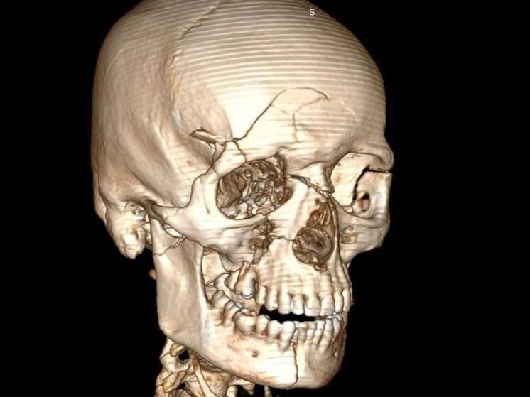 Врачам пришлось снимать скальп самокатчику, чтобы спасти его после падения