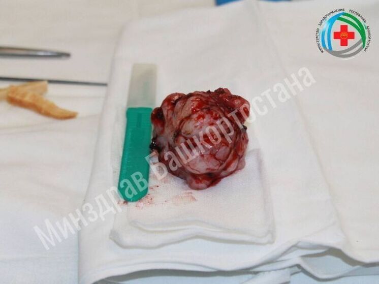 В Уфе хирурги спасли 75-летнюю женщину с большой опухолью мозга