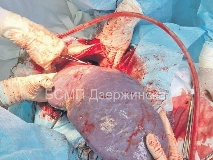 Нижегородке удалили селезенку, которая увеличилась в 4 раза