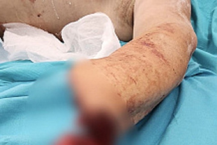 Нижегородские врачи пришили 61-летнему мужчине руку, отрезанную пилой