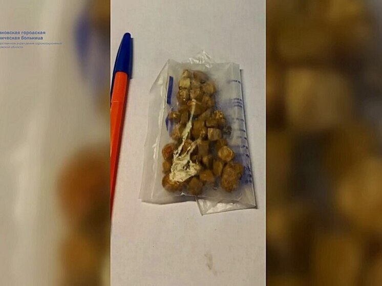 У жителя Балакова из мочевого пузыря достали 150 камней