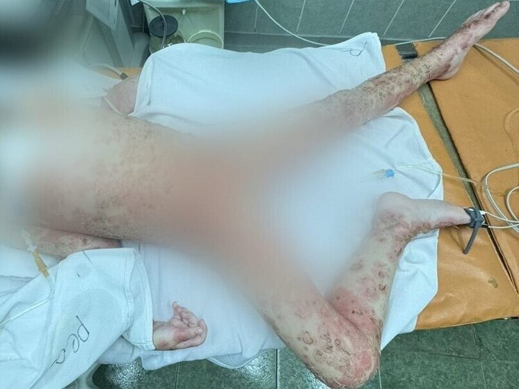 В Липецкой области врачи спасли 4-летнюю девочку после ожогов борщевиком