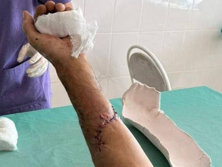 В Саратове хирурги спасли мужчине руку, почти отрезанную бензопилой