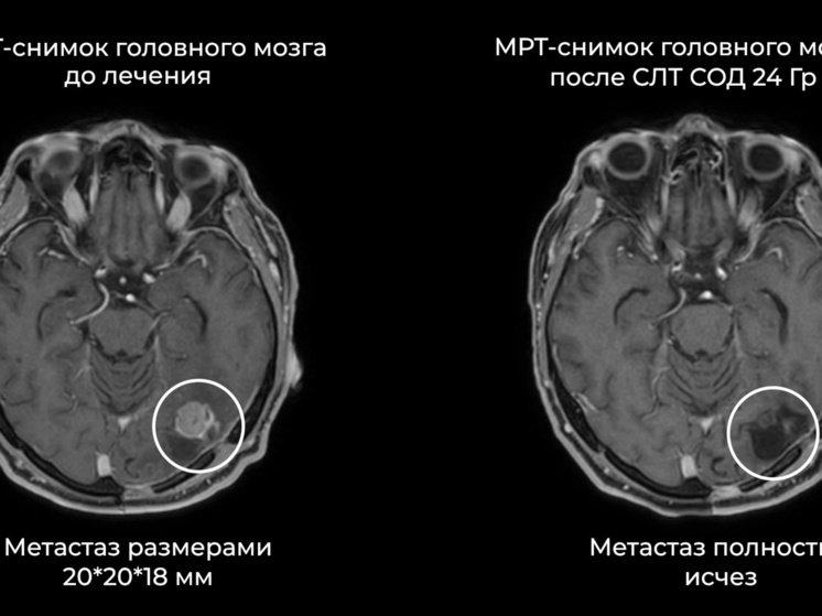 В Иванове пациенту удалили опухоль головного мозга без операции