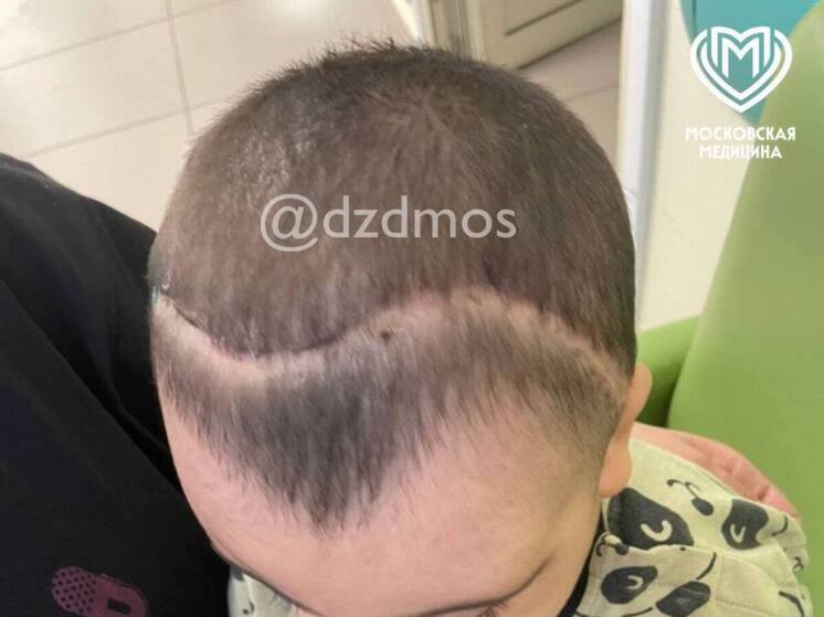 Редкую деформацию черепа исправили малышу московские врачи