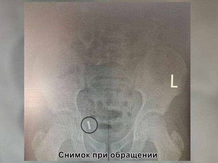 Воронежские врачи удалили у ребенка аппендикс вместе с проглоченными магнитами