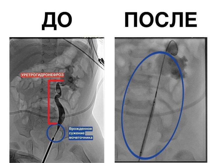Врачи Центра Рошаля спасли почку 5-месячному ребенку с помощью уникальной технологии