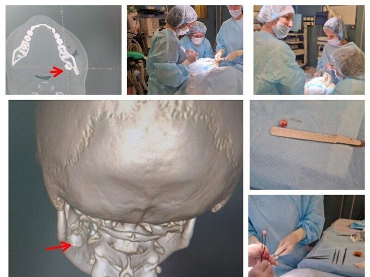 Зуб в щеке: в Чувашии хирурги извлекли инородное тело из мягких тканей ребёнка