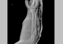 Воронежские хирурги успешно восстановили поврежденную локтевую кость пациента и добились заживления обширных повреждений мягких тканей благодаря комплексному подходу, включающему пересадку кожи и использование фиксирующих конструкций при переломе