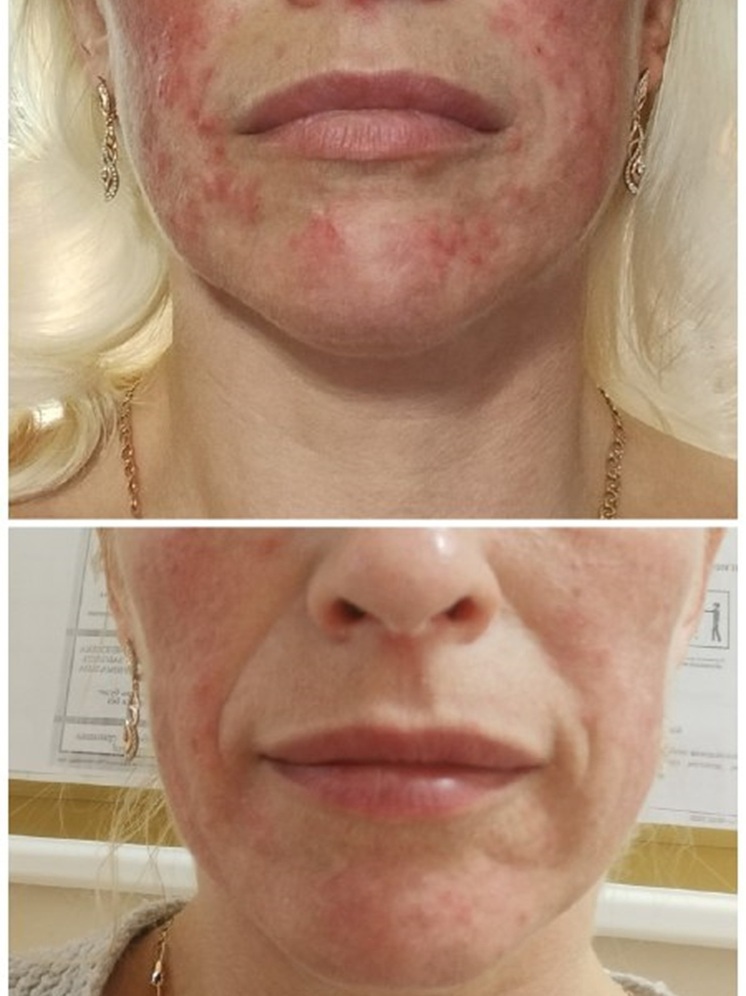 Опасность самолечения: случай стероидного дерматита у псковички напомнил о важности обращения к врачу