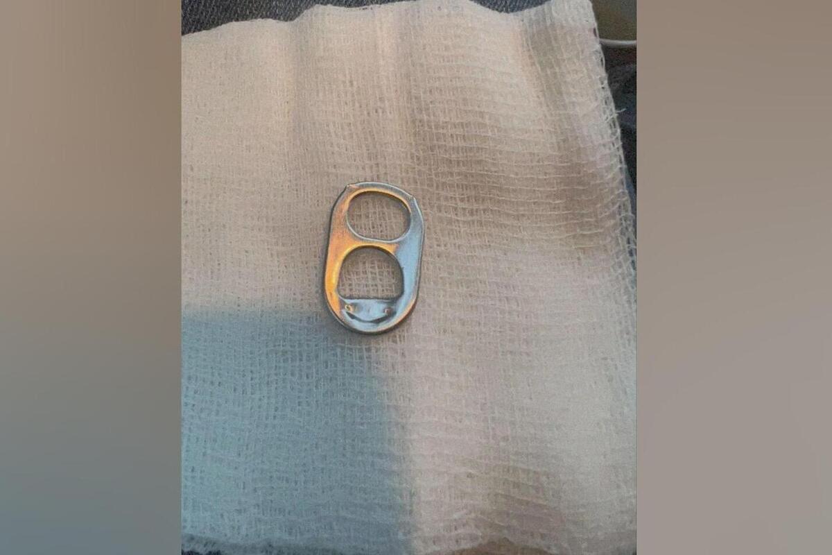 Bambino di un anno e mezzo salvato dopo aver inghiottito una chiave di lattina: l'importanza della vigilanza e della prevenzione nella sicurezza dei più piccoli