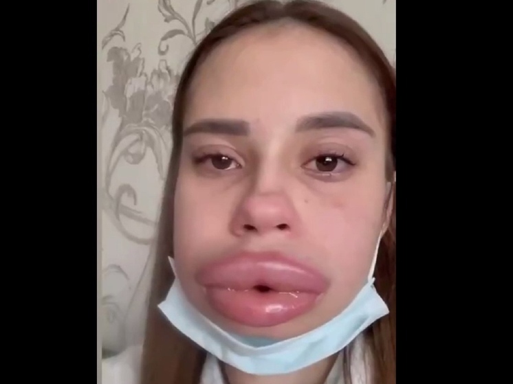 Девушка получила отек Квинке, пытаясь "сдуть" накачанные губы
