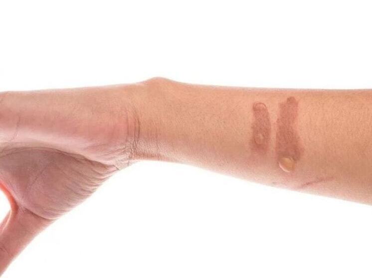 МЧС Псковской области напоминает о правилах оказания первой помощи при ожогах