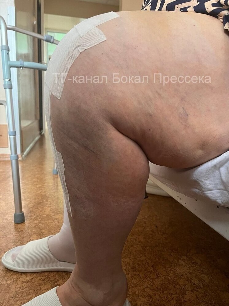 Нижегородку прооперировали под честное слово «похудеть»