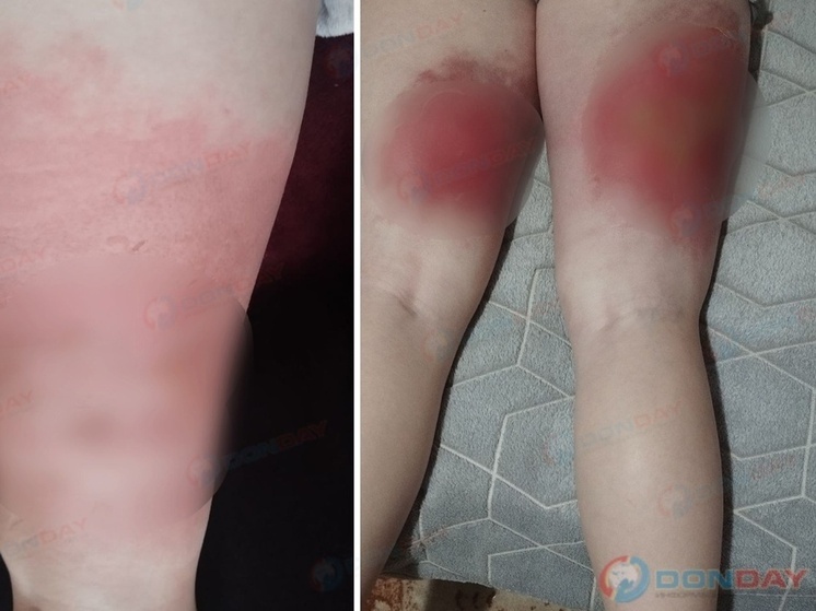 В Ростовской области девушка обварила ноги кипятком из-за лопнувшего крана в душе