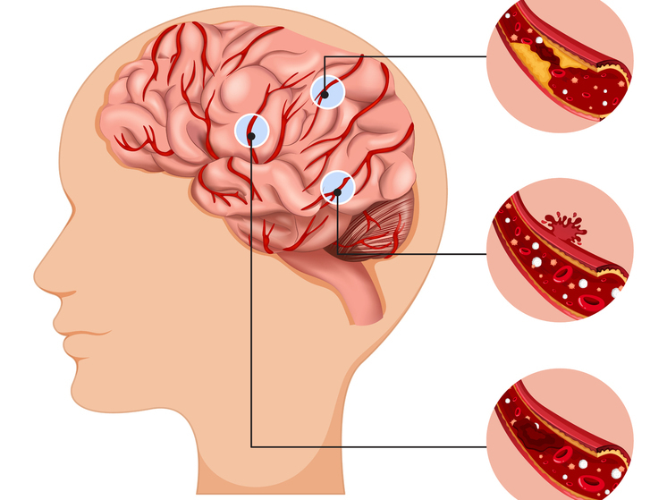 В День борьбы с инсультом нижегородцам напомнили о профилактике