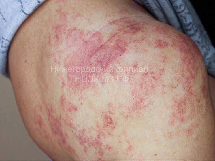 Нижегородские врачи спасли пациентку с последствиями укуса гадюки