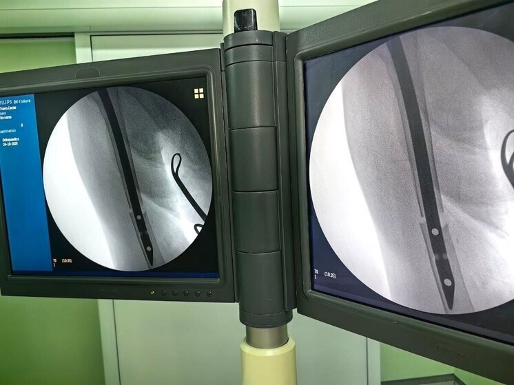 В Сургуте врачи провели уникальную операцию 92‑летней пациентке с переломом плеча
