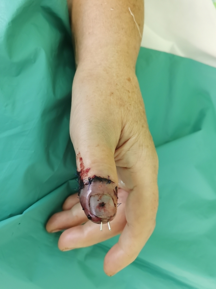 Ярославские садоводы отстригают себе пальцы электросекаторами