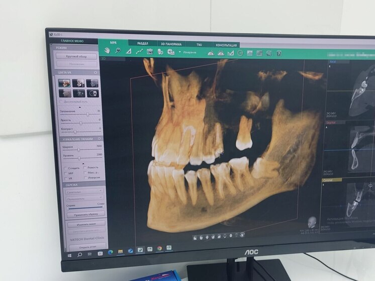 Вопрос о том, когда лучше выбрать виниры, а когда коронки, часто вызывает затруднения у пациентов. Специалисты подчеркивают, что это не просто вопрос эстетики, а медицинская необходимость, зависящая от состояния зубов. Об этом рассказали врачи Киришской стоматологической поликлиники.