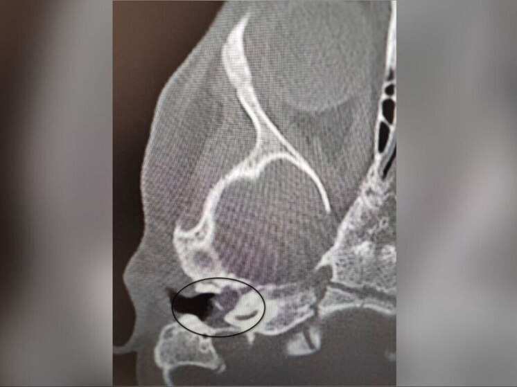 Воронежские медики спасли от глухоты двухлетнюю малышку
