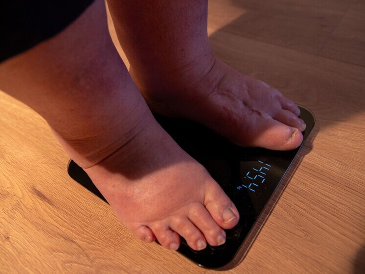 «Газета.Ru»: проверяться при отеках нужно у эндокринолога