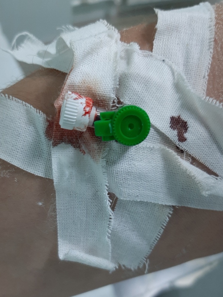 Балаковская пенсионерка вспорола живот сопернице