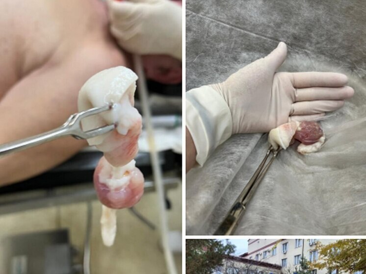 В Балакове мужчина подавился слишком крупным куском сала