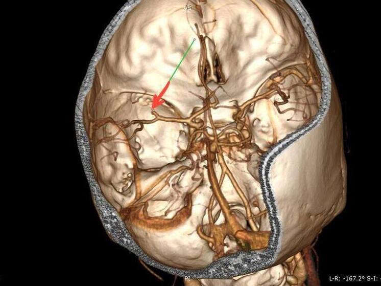 В Воронеже женщина перенесла инсульт на работе из-за сильного стресса