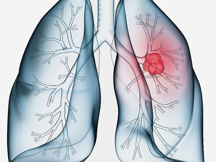 Тревожная статистика по раку легких во Владимирской области: почти 500 новых случаев за год