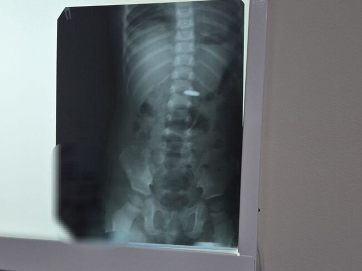 Врачи в Балакове спасли годовалого ребенка, проглотившего батарейку